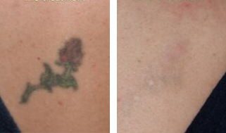 Eliminación de tatuajes 3