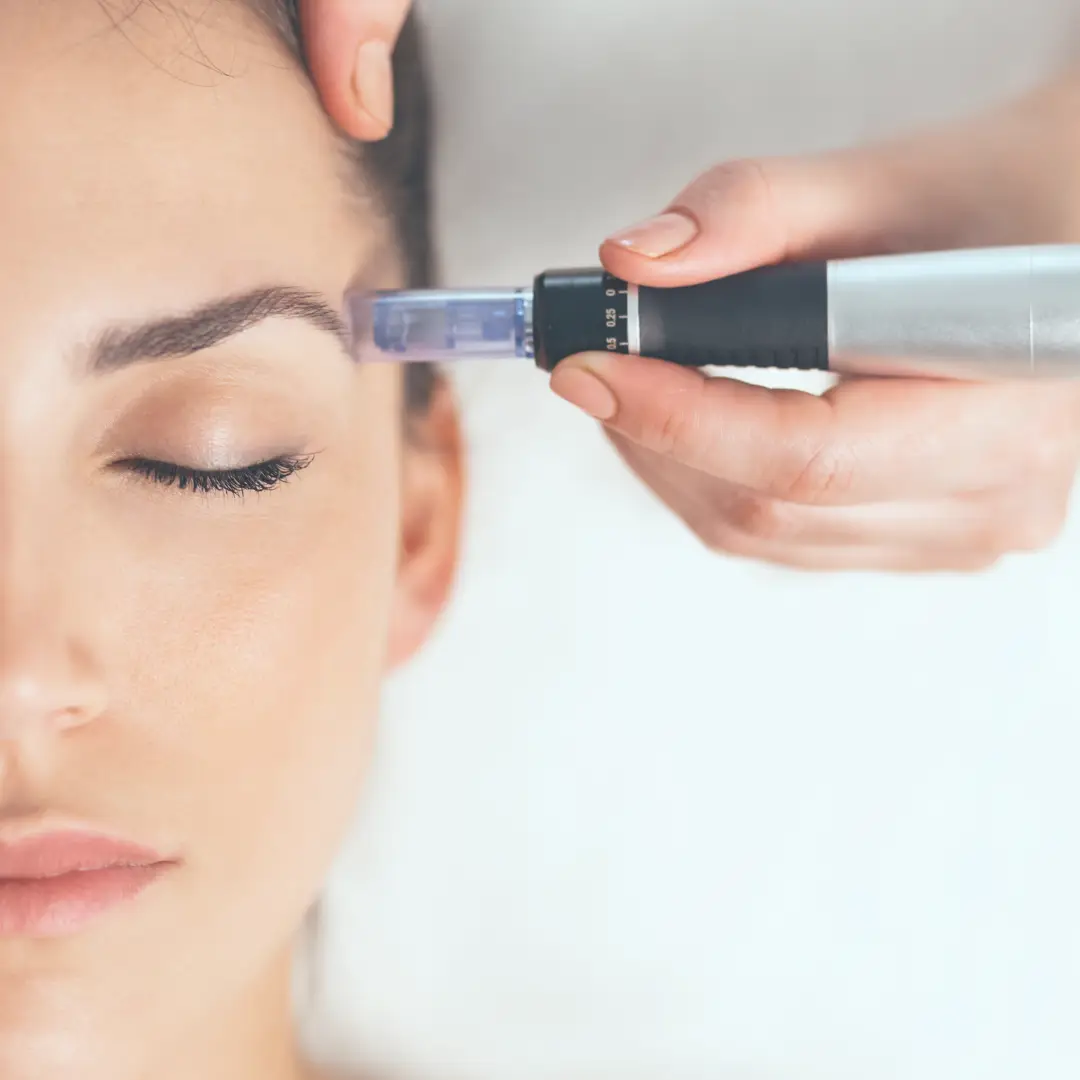 Dermapen, micronedling